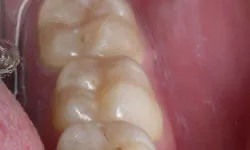 Teeth after with white filings 